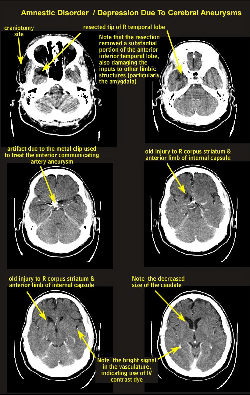 /images/visn6/case1_CT.jpg